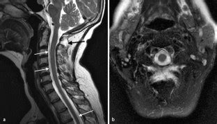 liquorverlustsyndrom symptome|Spinal Fluid Leakage Syndrome (Liquor Loss)